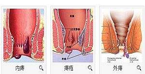 厦门混合痔治疗手术多少钱